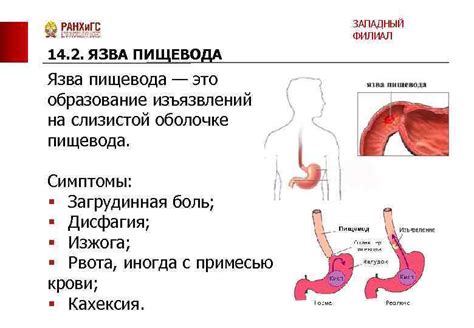 Причины короткого пищевода у взрослых