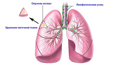 Причины кровохарканья при раке легких