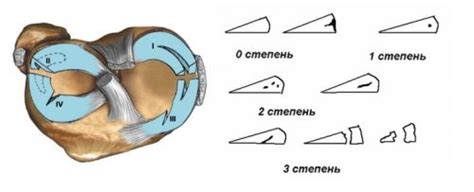 Причины мениска 3а степени