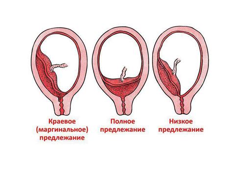 Причины низкого расположения хориона по передней стенке матки