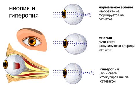 Причины развития гиперметропии в правом глазу