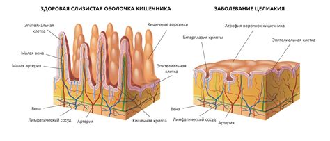 Причины развития непереносимости глютена