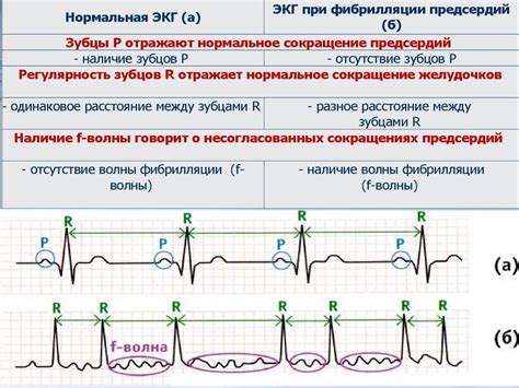 Причины ускоренного предсердного ритма