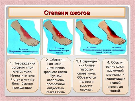 При ожоге 1 степени: что делать и как реагировать правильно