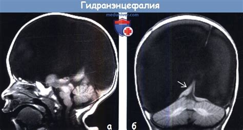 Проблема отсутствия мозга