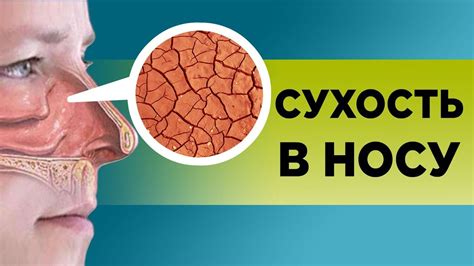 Проблема сухости в носу