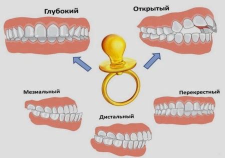 Проблемы с неправильным прикусом