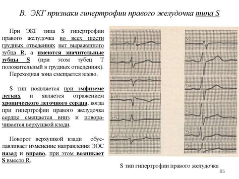 Прогноз и возможные осложнения изменения миокарда левого желудочка