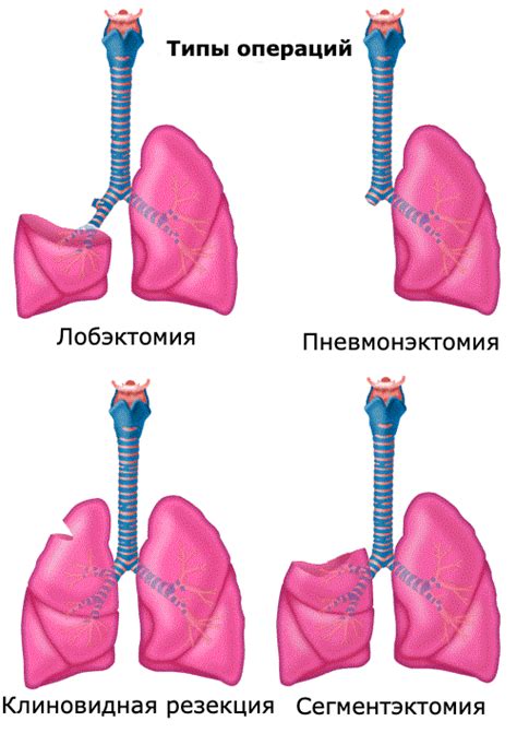 Прогноз и лечение пациентов с EGFR мутацией при раке легкого