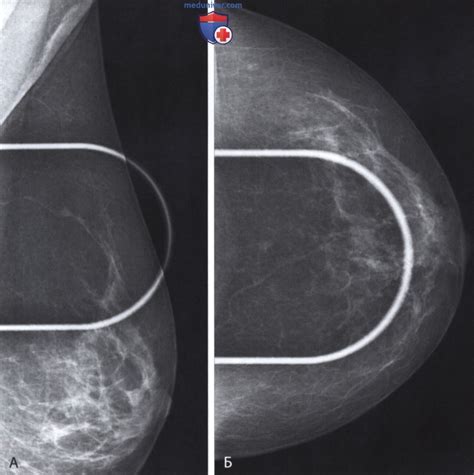 Проекции маммографии