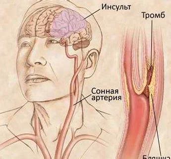 Простуда и суставы: связь со шумом в голове