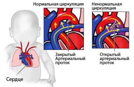 Профилактика ВПС у детей