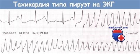 Профилактика и лечение С-типа ЭКГ