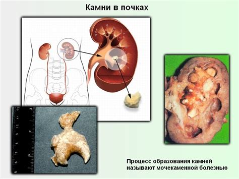 Профилактика образования камней в почке