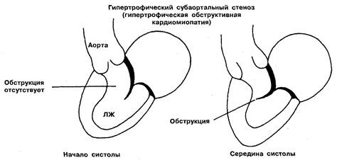 Профилактика обструкции выносящего тракта левого желудочка