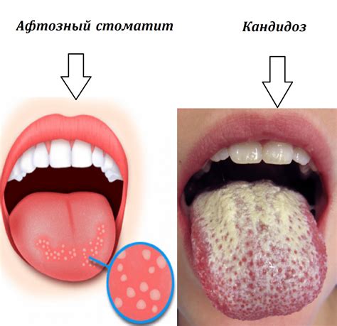 Профилактика ран на языке и полоскание рта