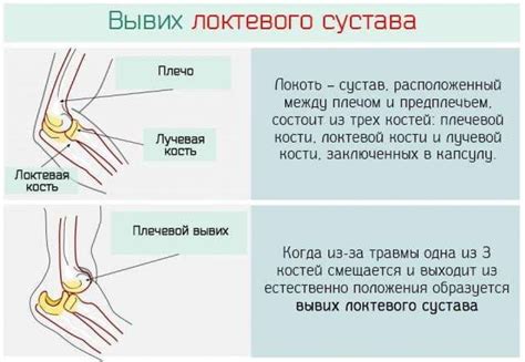 Профилактика растяжения связок локтевого сустава