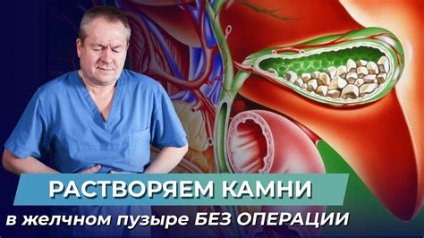 Профилактические меры для предотвращения образования камней в желчном пузыре