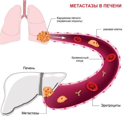 Процесс метастазирования и распространение раковых клеток