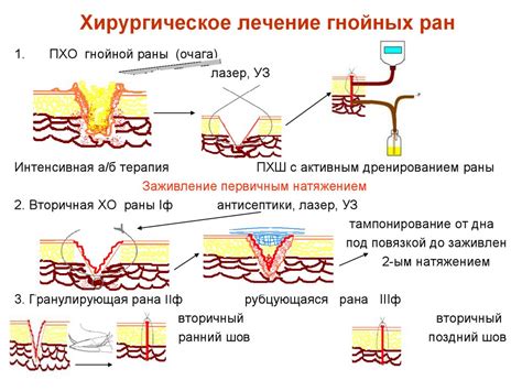 Процесс подсушки мокнущей раны