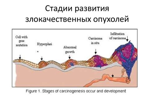 Процесс развития опухоли