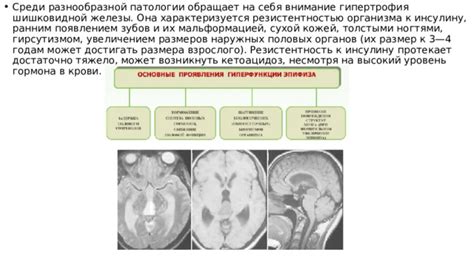 Различные патологии эпифиза и их последствия