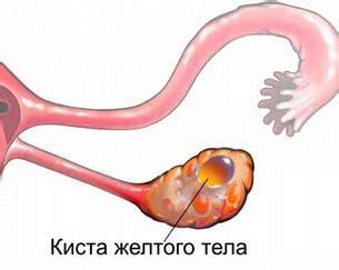 Разрыв желтого тела яичника