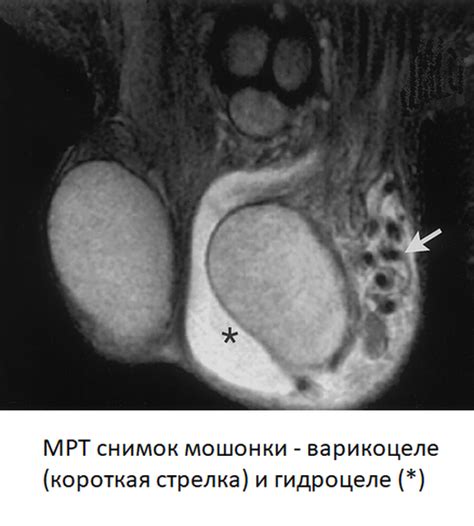 Рак мошонки как возможная причина опухоли