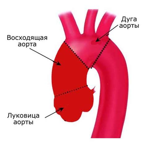 Расширенный восходящий отдел аорты: что это такое?