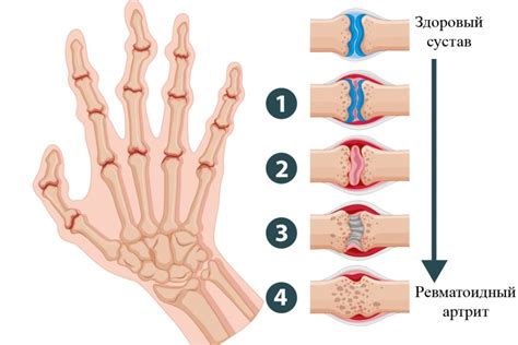 Ревматоидный артрит и увеличение суставов на пальцах рук