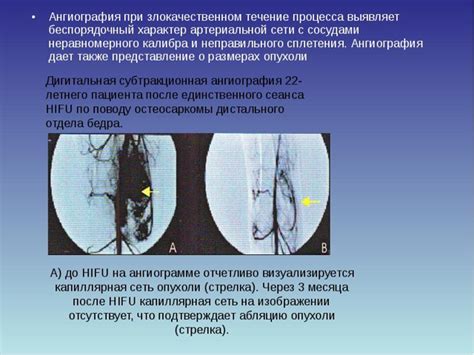 Результаты и диагностика ангиографии