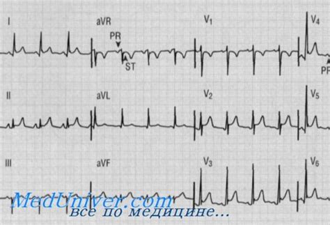 Результаты применения метода Т сглажен в отображении AVL