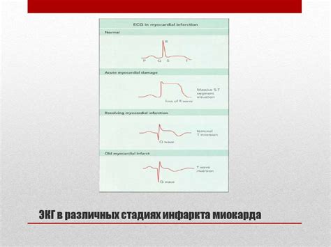 Риски и осложнения С-типа ЭКГ