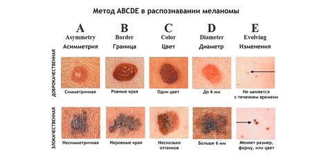 Родинки на руках и рак кожи: важность регулярного наблюдения