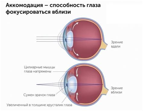 Роль аккомодации в офтальмологии