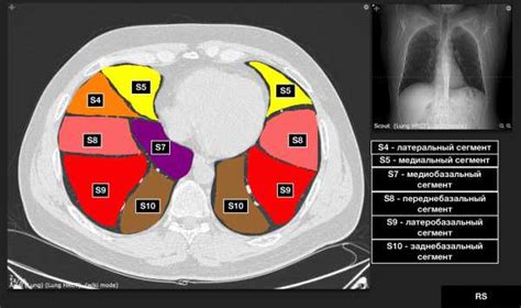 Роль S6 правого легкого на КТ