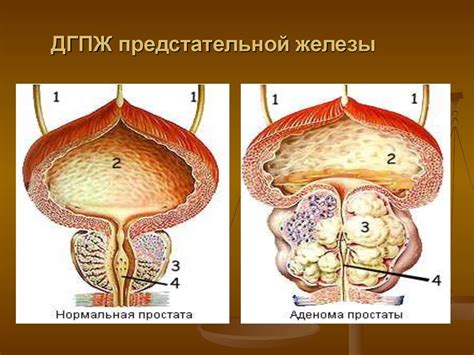 Связь между ночной поллакиурией и заболеваниями предстательной железы