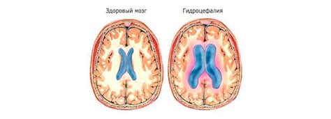 Связь надувания щек с давлением внутри черепа