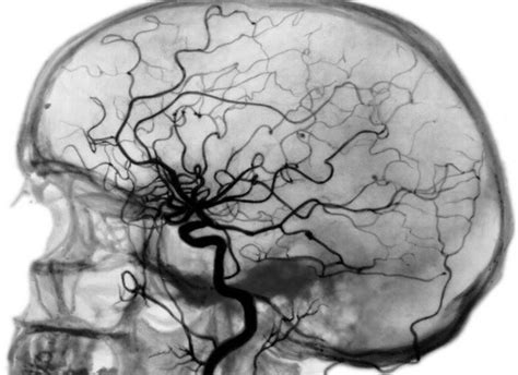 Селективная ангиография сосудов головного мозга