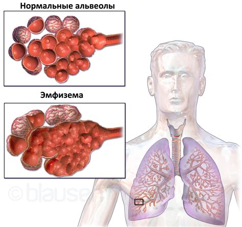 Симптомы бифуркационного лимфоузла в легких