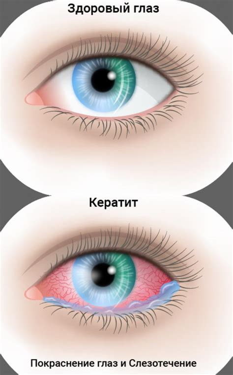 Симптомы воспаления роговицы глаза