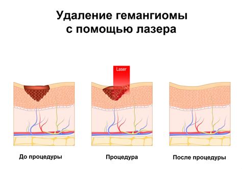 Симптомы гемангиомы у взрослых женщин