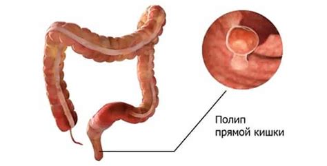 Симптомы гиперплазии в прямой кишке