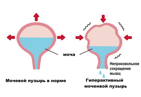 Симптомы гиперфиксации РФП в мочевом пузыре