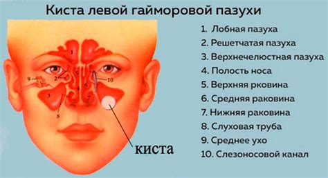 Симптомы грибкового поражения гайморовой пазухи