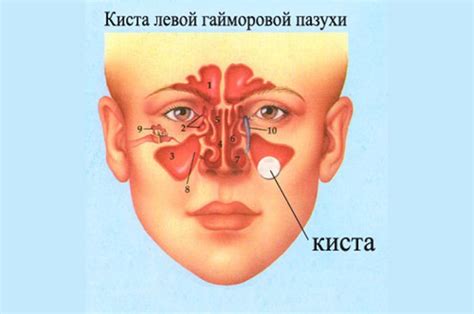 Симптомы затемнения гайморовых пазух