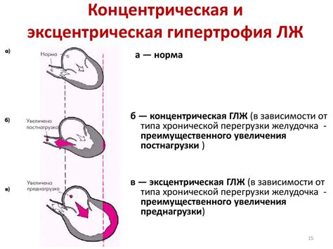 Симптомы изменения миокарда левого желудочка