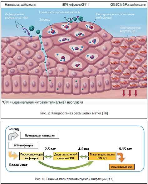 Симптомы интраэпителиальной неоплазии высокой степени