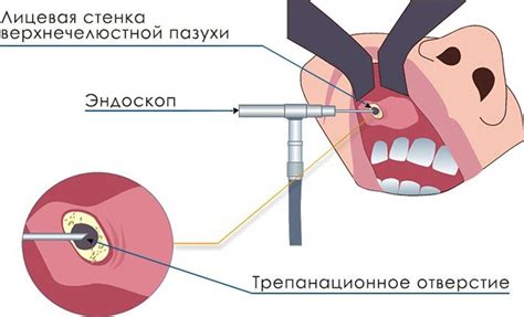 Симптомы и диагностика изменений в верхней стенке пазухи