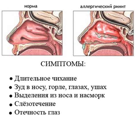 Симптомы и последствия ночного отека носа